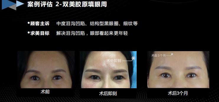 胶生灌养眼周抗衰是什么产品？