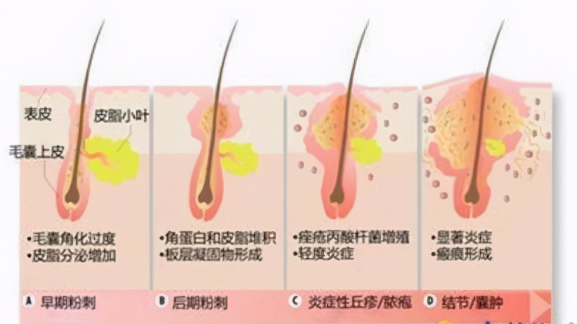昆明祛除痘印痘坑,如何祛除痘印痘坑效果好