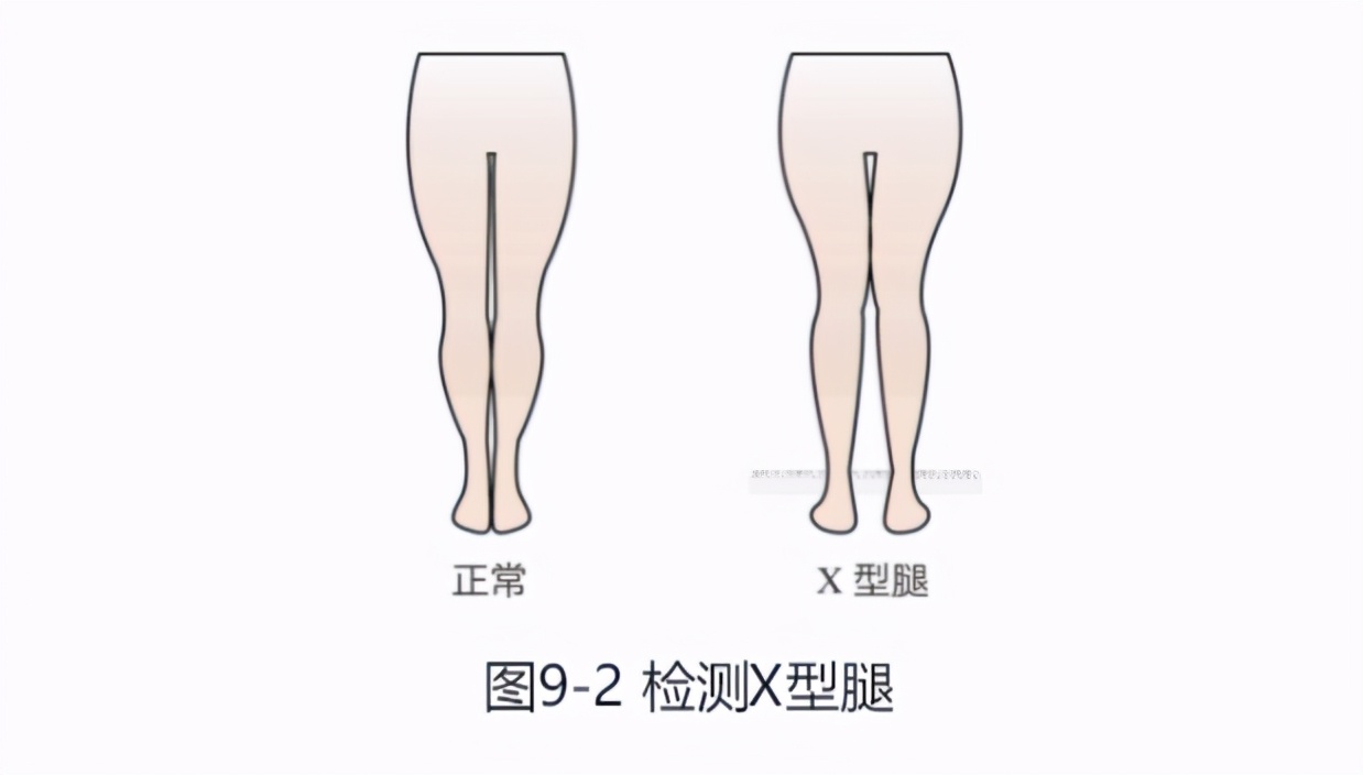 扁平足穿上了矫正鞋垫能跑步吗,扁平足跑步选减震还是缓冲