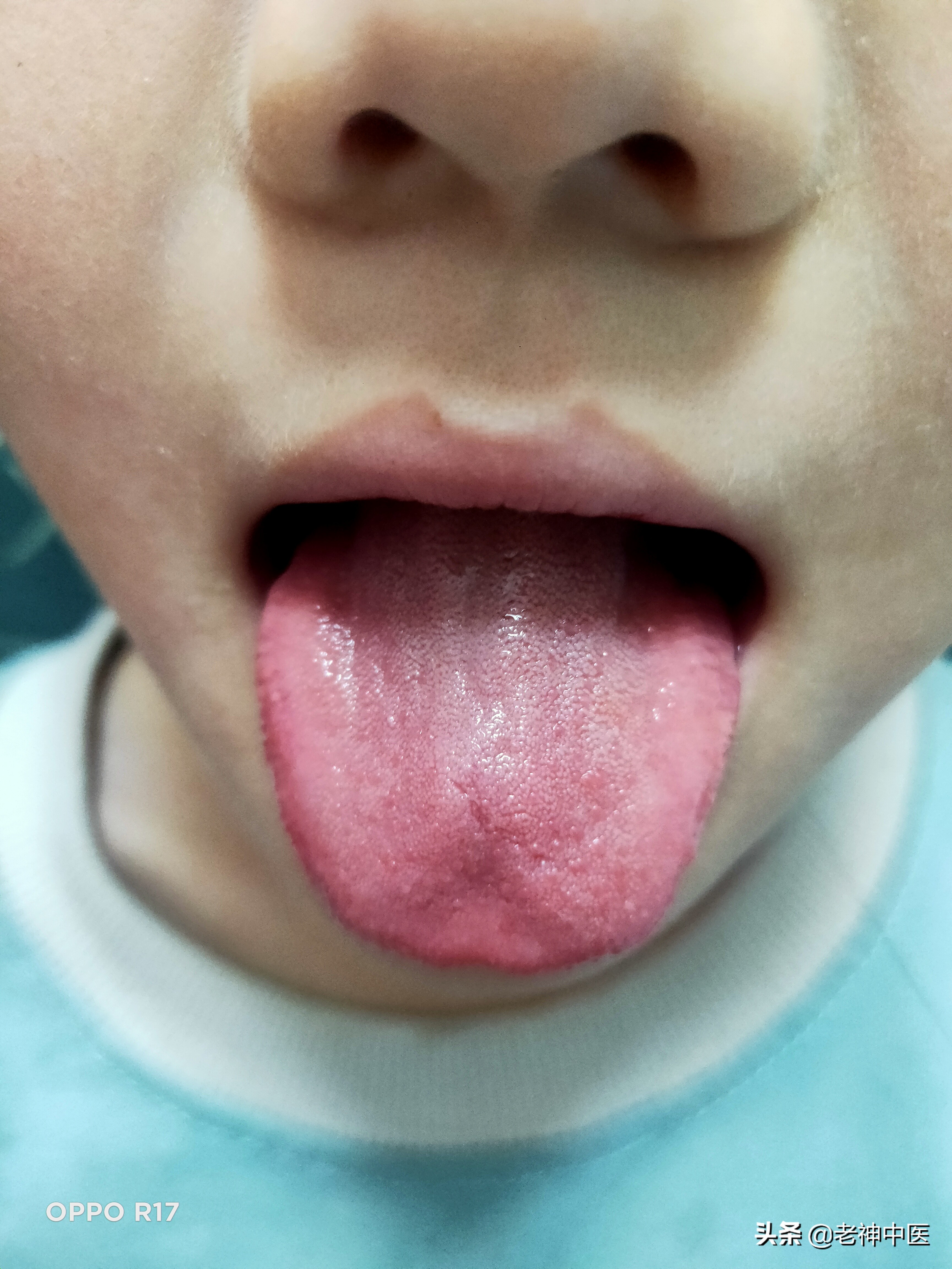 儿童感冒发烧反复需要吃消炎药吗,孩子感冒经常打针好吗