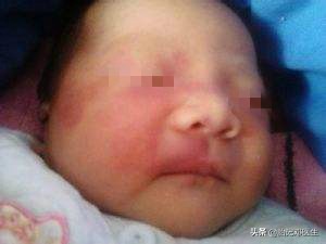 为什么红胎记会突出皮肤表面,为什么红胎记这么难治疗