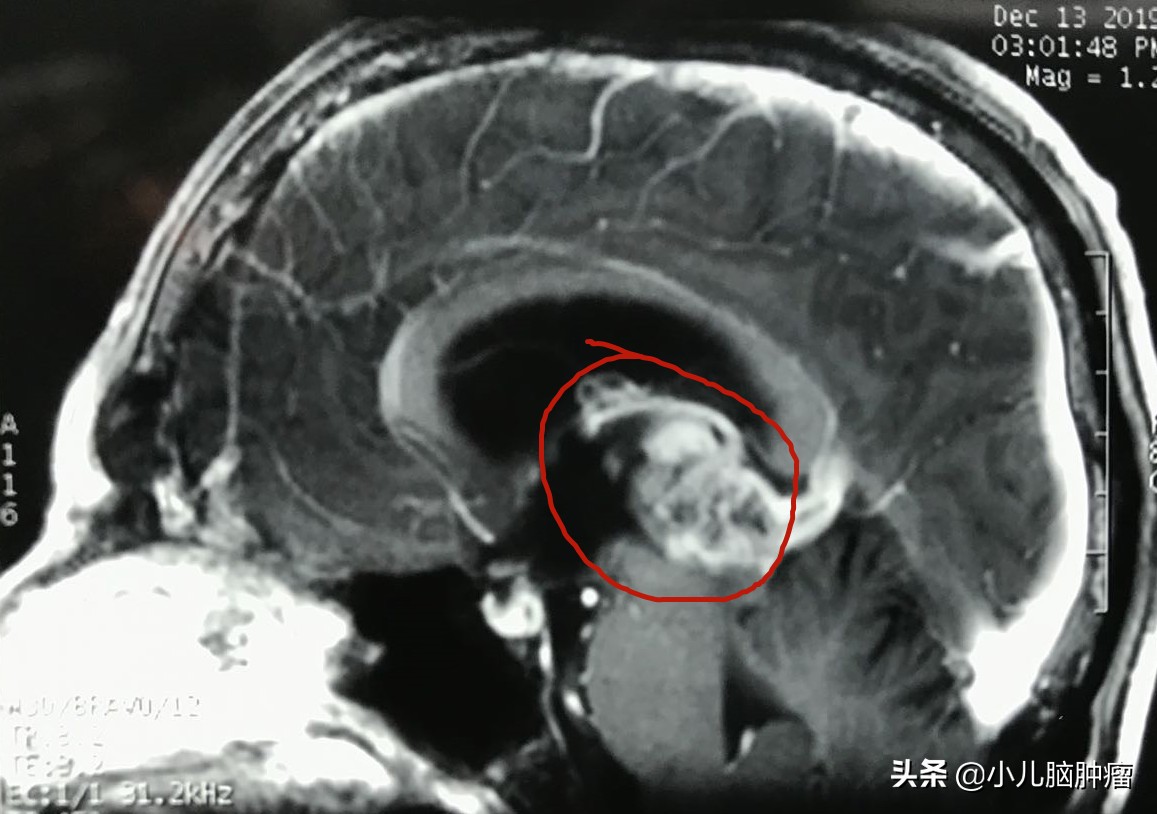 一例位于松果体区和三脑室内的肿瘤