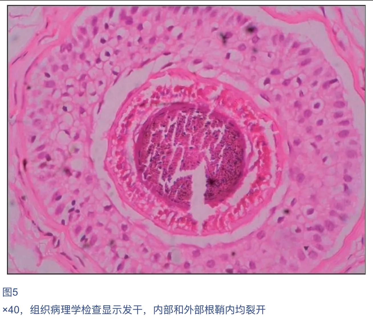 儿童脱发会是什么病的前兆,孩子毛囊引起的脱发怎么办