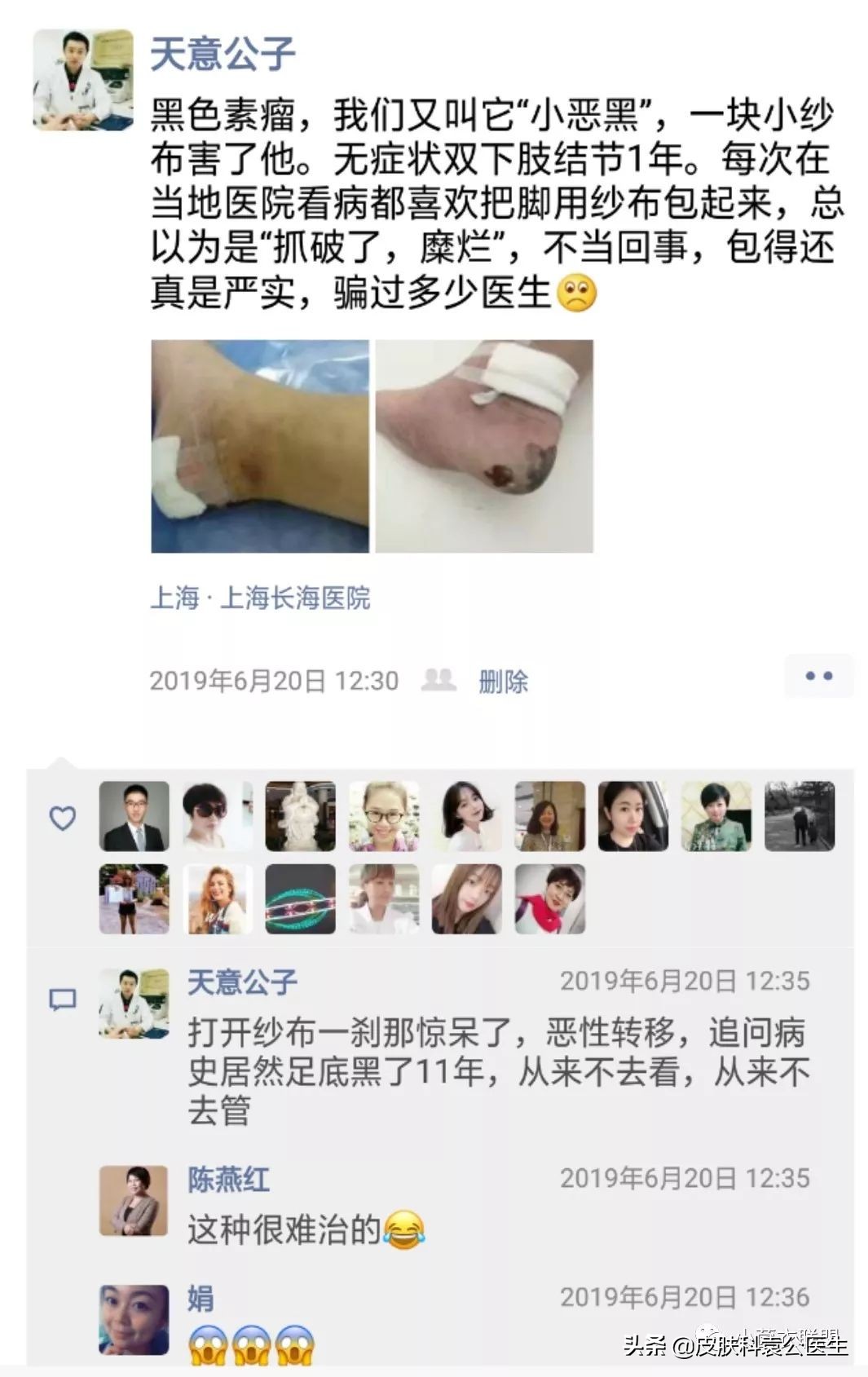 边缘不整齐的痣都是黑色素瘤吗,痣突然变大不规则一定是黑色素瘤