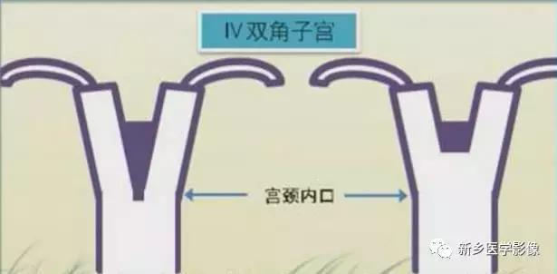 子宫发育异常,应想到的6大类常见畸形