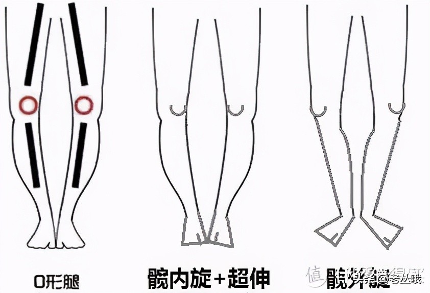 成年后o型腿是什么原因造成的,成人o型腿怎么矫正最有效的方法