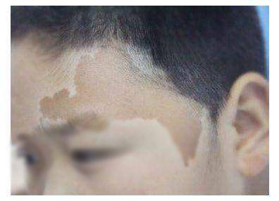 人为什么要有胎记胎记怎么来的,好胎记还是坏胎记专家教你识别