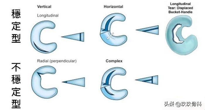 带你了解「半月板损伤术后康复」四个阶段