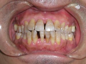 牙齿松了如何固齿,撞松牙齿松动了怎么样才能固齿