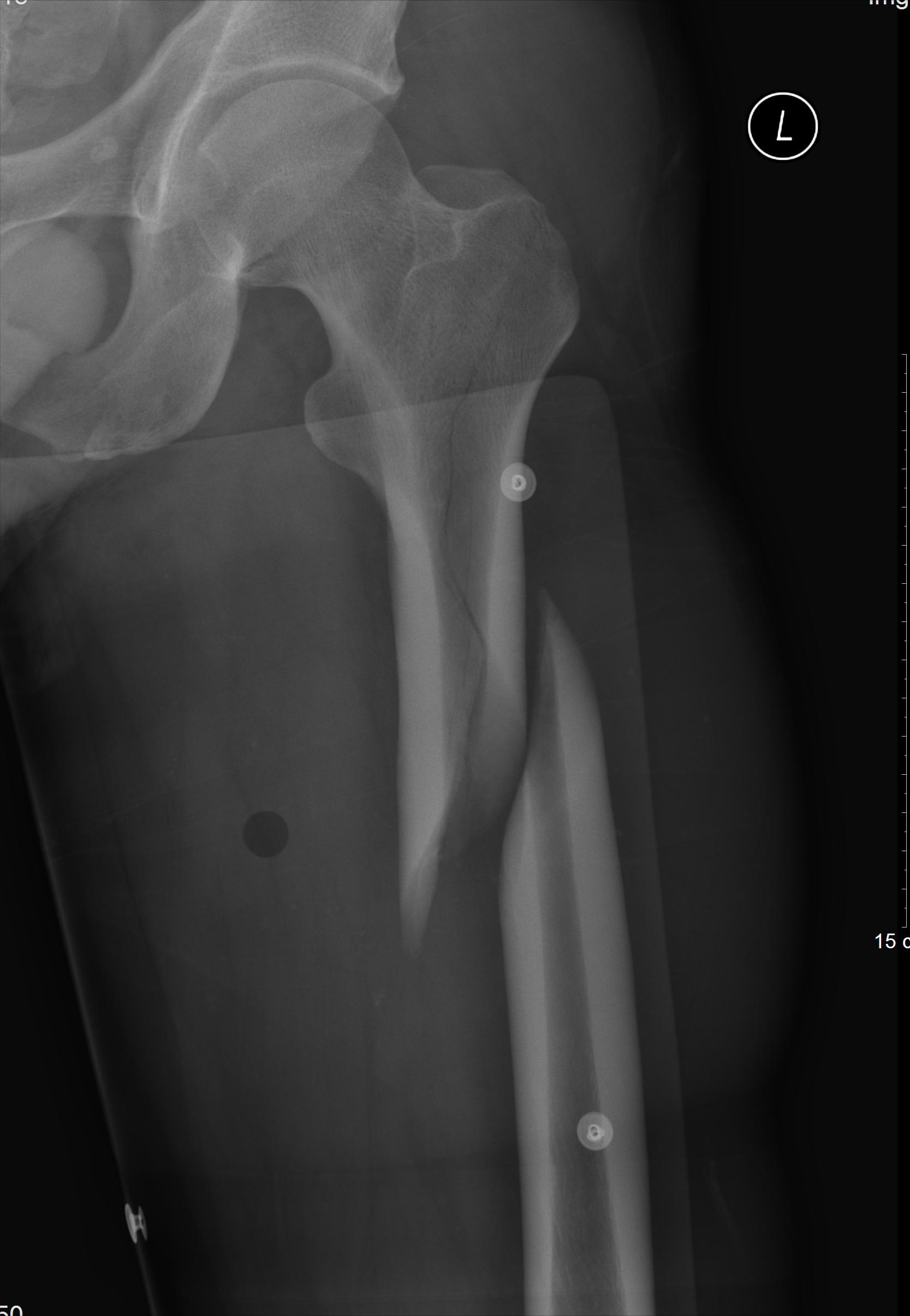 从瘫痪到重新站起来,瘫痪后重新站起来的有吗