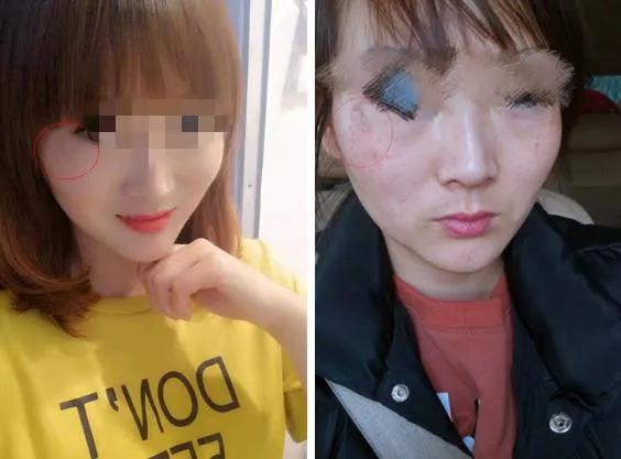 郑州女子祛斑效果,祛斑产品毁容案例
