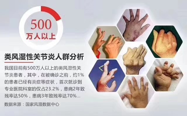 清早起床手指关节僵硬是关节炎吗,类风湿关节炎的表现有哪些