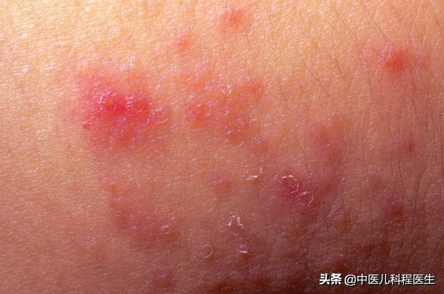 宝宝湿疹怎么治疗才好,宝宝湿疹如何内调