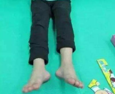 儿童走路外八字怎么解决,小孩走路外八字如何改变