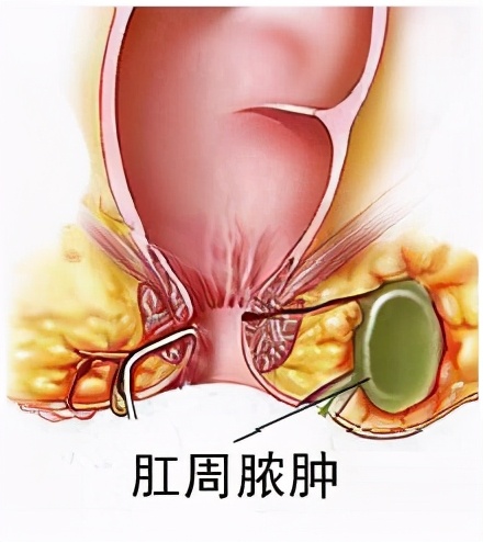 刚做了肛周脓肿怎样恢复得快,根除肛周脓肿的特效药