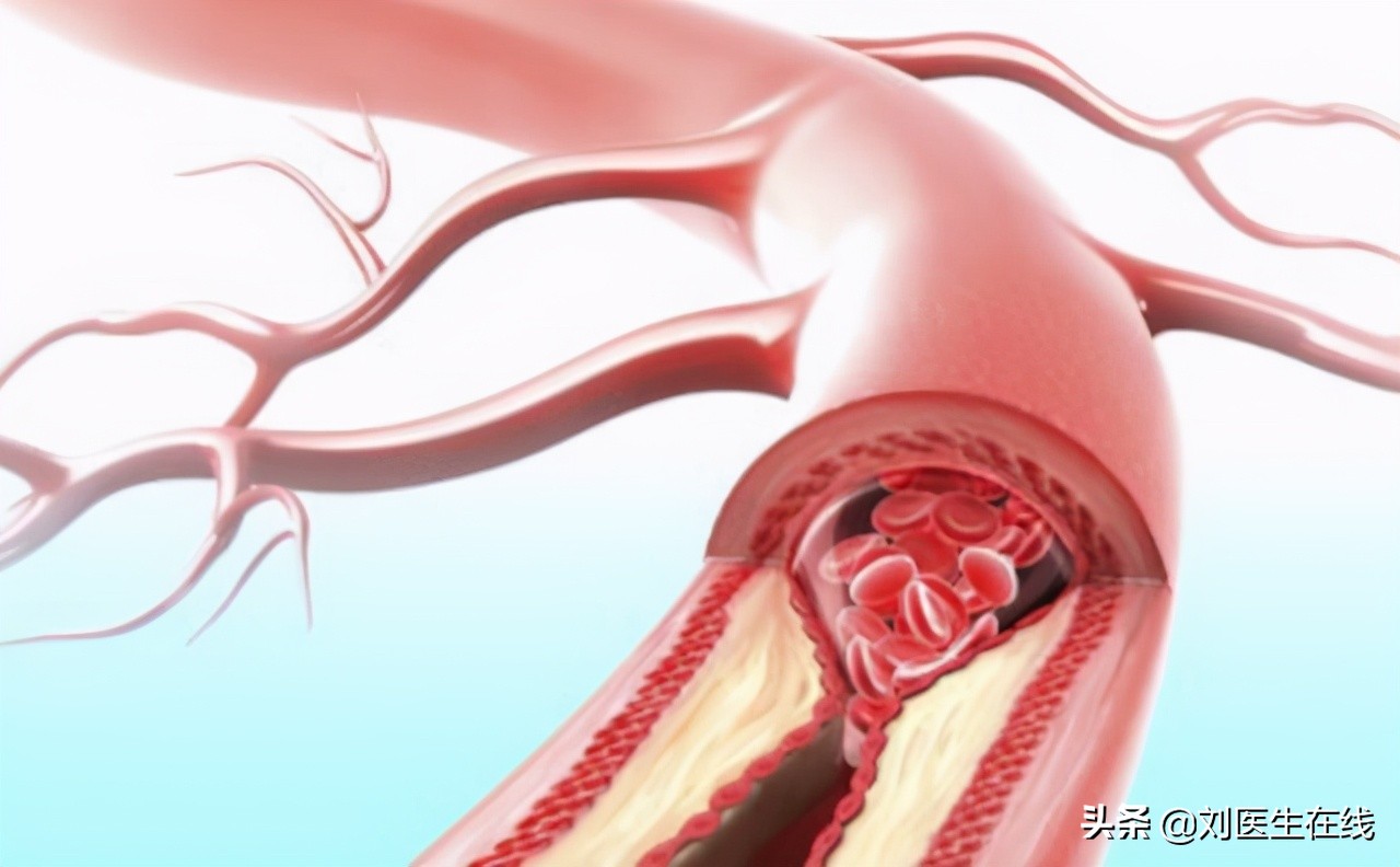颈动脉有斑块就要吃他汀,颈动脉斑块究竟用不用吃他汀