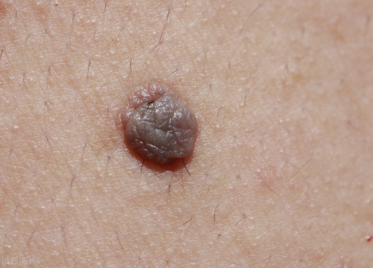 感染hpv再打疫苗会有什么状况,感染hpv可以直接打疫苗吗