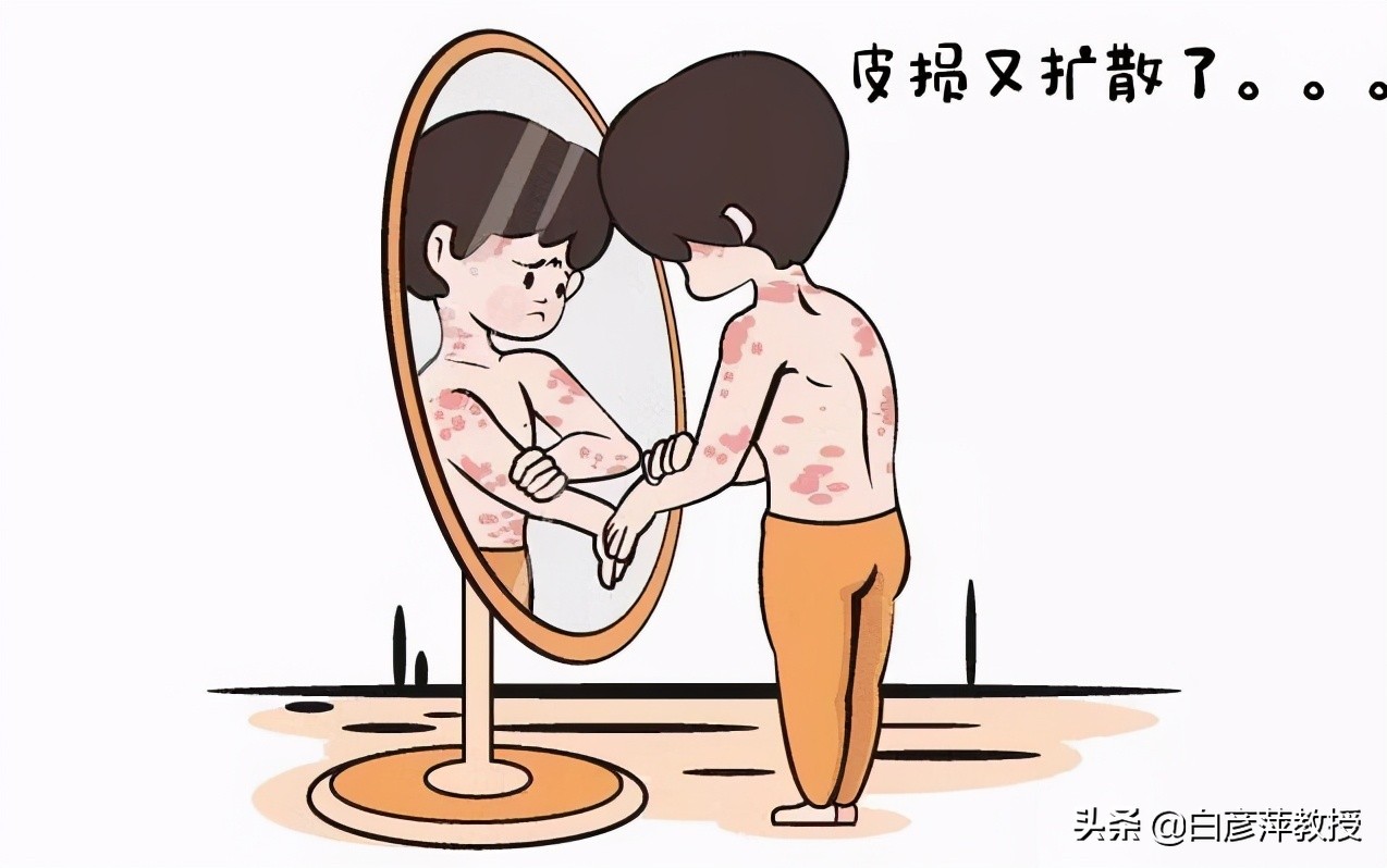 “难缠”的银屑病,能让“它”彻底“消失匿迹”吗?