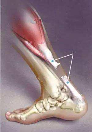 跟腱手术后康复用什么药,跟腱术后需要注意什么