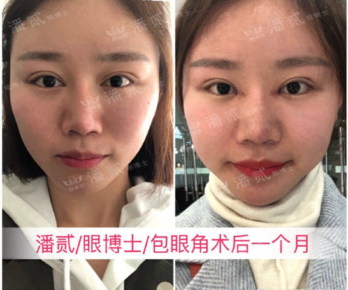 开眼角过大图片,开眼角过大修复效果图