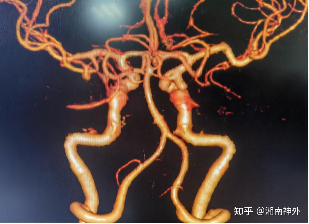 脑动脉瘤的定时炸弹,颅内定时炸弹