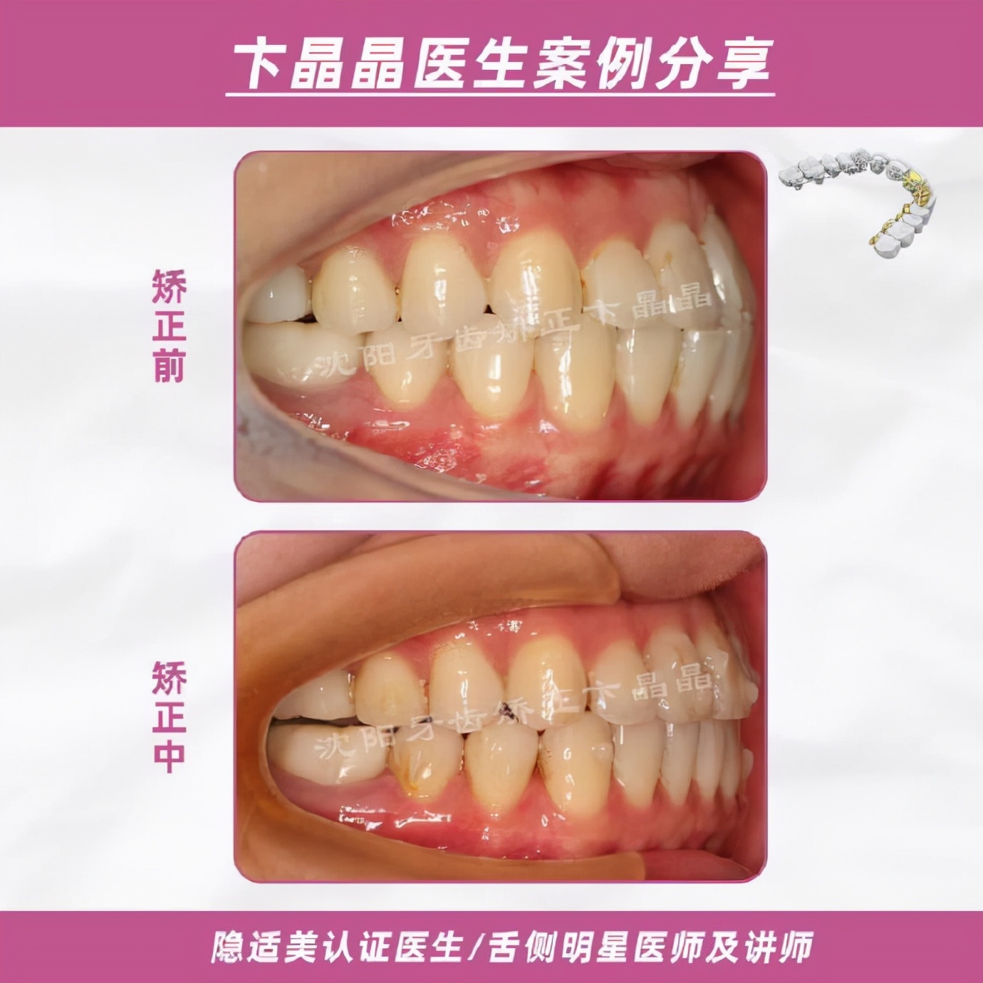 隐适美牙套矫正过程,隐适美个别牙反颌矫正真实案例