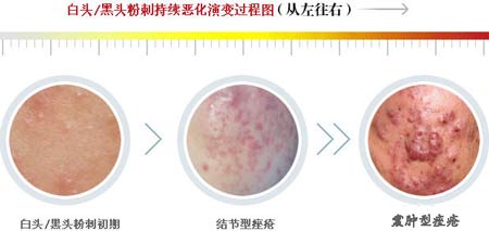 丘疹性痘痘肌肤怎么治疗,如何彻底根治丘疹型痘痘