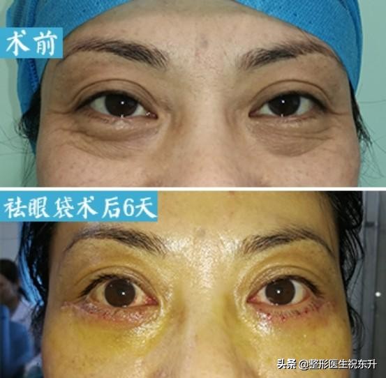 用鸡蛋去眼袋最快最好方法,滚鸡蛋去眼袋