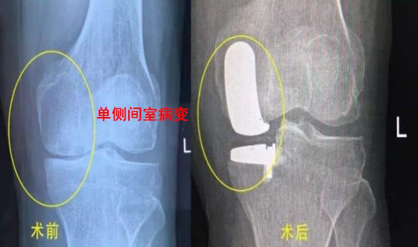 老年人骨性关节炎膝盖疼怎样锻炼,老年人膝关节骨关节炎首选检查