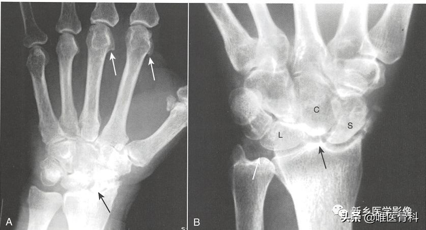 骨质增生引起的骨关节疼痛怎么治,30多岁退行性骨关节病怎么办