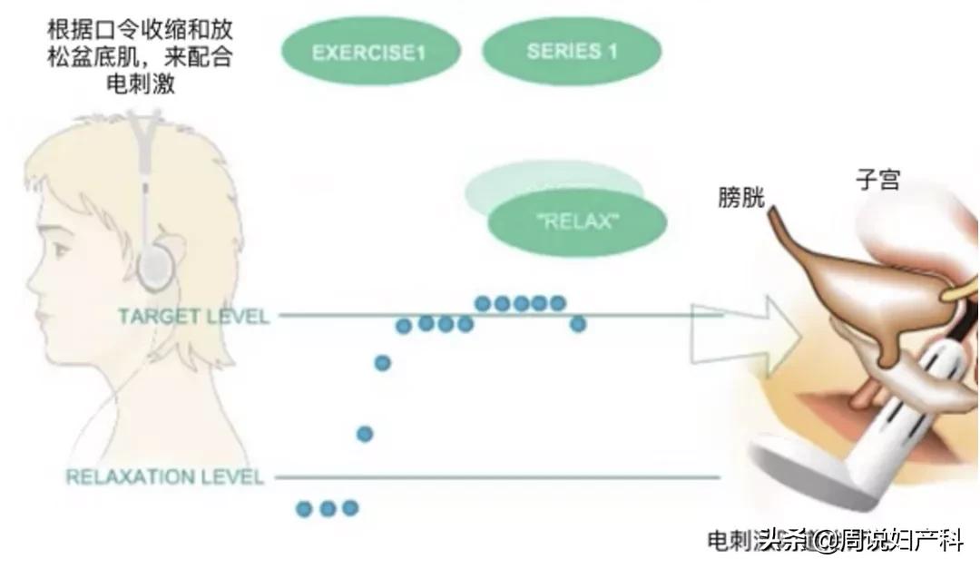 生完孩子后憋不住尿,生完孩子憋不住尿怎么办