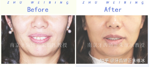 南京牙齿矫正龅牙前突要多少钱,36岁牙周不好龅牙能整吗