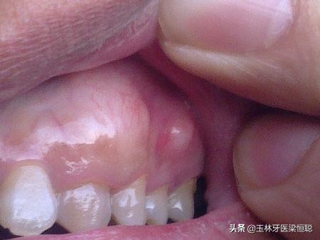 张口呼吸会导致牙槽骨突出吗,牙槽骨突起来了怎么办