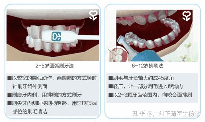广州隐适美：整牙过程中如何维护口腔卫生