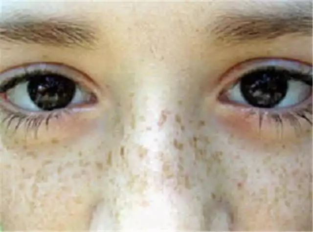 眨眼睛面部肌肉跟着动是什么原因,面部三叉神经痛是什么原因造成的