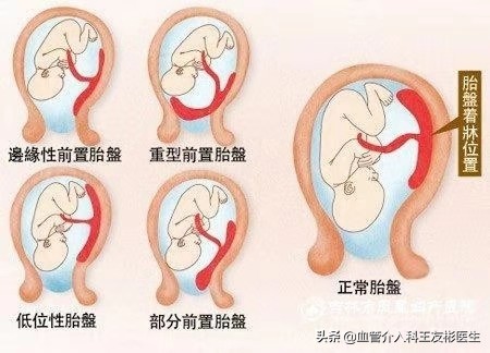 产妇遇凶险性前置胎盘,凶险性前置胎盘产妇医生全力抢救