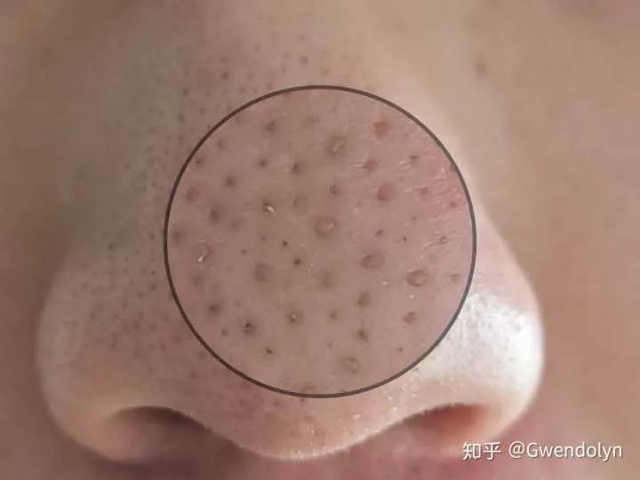 去除黑头只需一招简单有效不花钱,男生鼻子上黑头多去除最好的方法