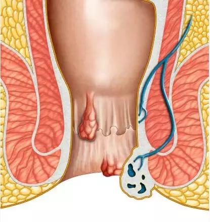 肛肠科常见便血性疾病的鉴别,偶尔便血是痔疮吗