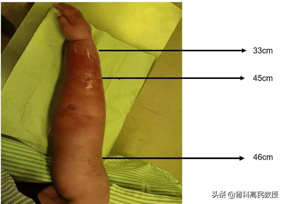 尿毒症手臂造瘘,乳腺癌十年胳膊肿了会有危险吗