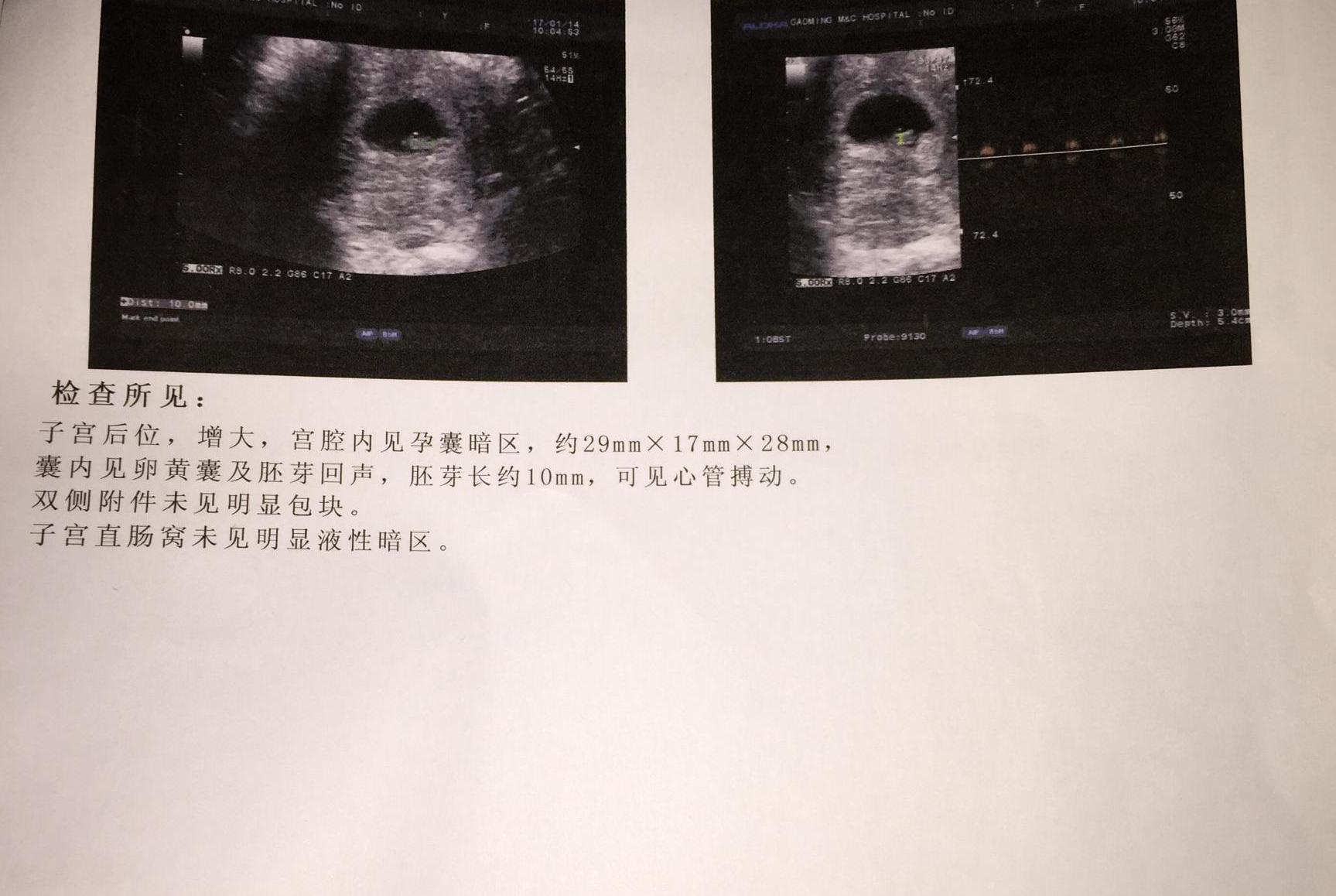 b超孕囊有错误吗,b超单显示孕囊有回声什么意思