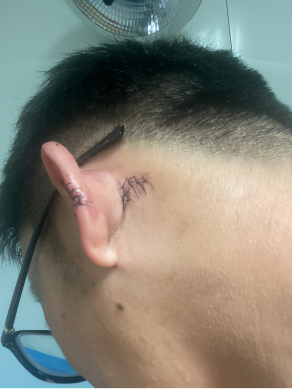 客人穿一次性拖鞋洗澡摔倒,游客在酒店摔伤正常赔多少