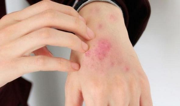 过敏性皮炎和梅毒疹有什么区别,不痒的皮疹都是梅毒疹吗