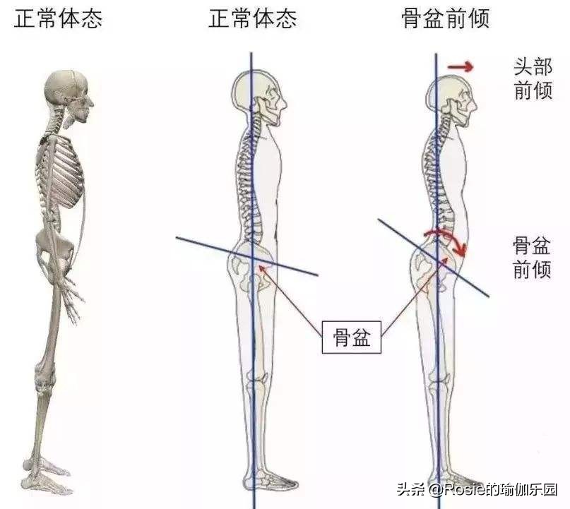 大腿根缝隙大o型腿怎么矫正,穿软鞋子造成o型腿怎么矫正