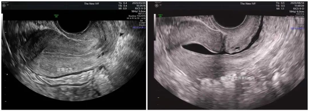 宫腔积液怎么排干净,宫腔积液怎么治疗最快