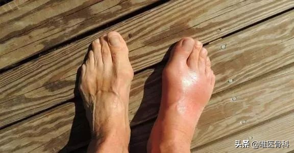 什么是痛风以及痛风的症状有哪些,痛风是由什么引起的怎样防痛风