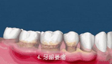 洗牙后牙龈一直出血用什么药止血,洗牙后出血凝结成血块包住了牙齿