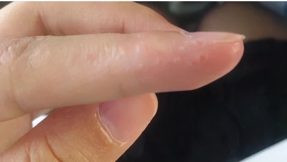 手指头脱皮是缺乏哪种维生素,脚脱皮是什么原因缺乏什么维生素