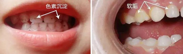 6岁孩子蛀牙发黑不配合怎么处理,3岁孩子蛀牙发黑怎么办