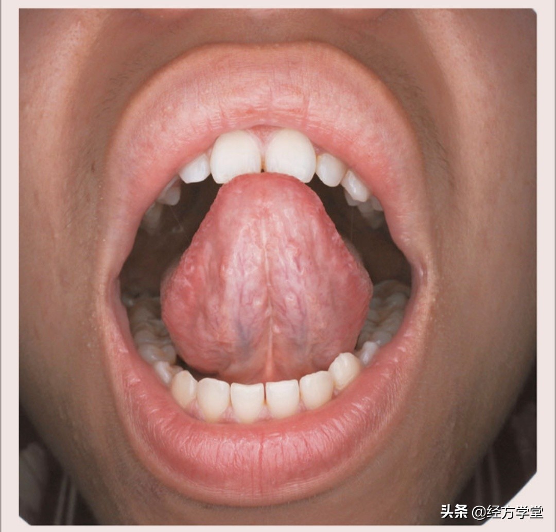 观舌养生舌诊入门一学就会,舌诊图片与经方治疗
