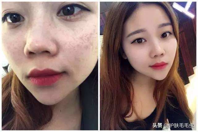 脸颊两侧长斑的原因，脸上长斑怎么消除？三种方法，立竿见影